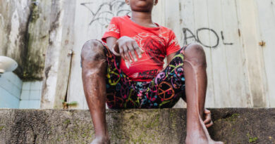 Teen Burn Survivor Walks into New Life After Free Surgery from Mercy Ships
