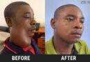 Ndola Teaching Hospital Removes 845-Gram Tumor, Transforms Life of Chingola Barber