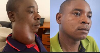 Ndola Teaching Hospital Removes 845-Gram Tumor, Transforms Life of Chingola Barber