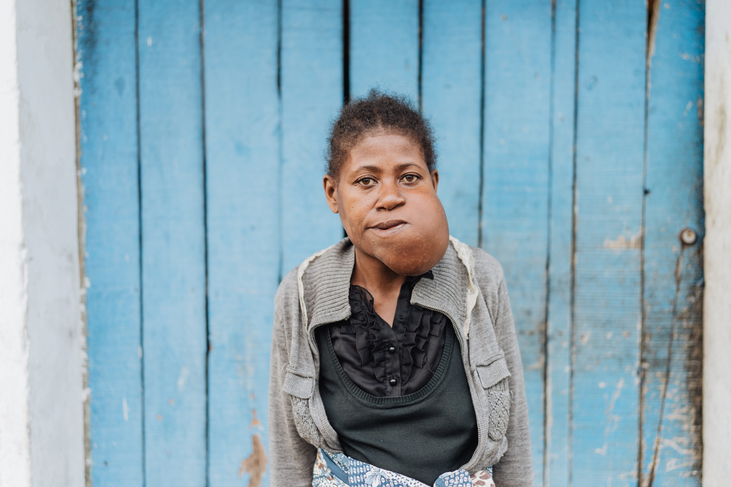 Malagasy Mother Receives Life-Changing Surgery After 10 Years with Tumour